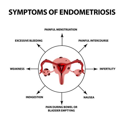 Endometriosis Illustrations, Royalty-Free Vector Graphics & Clip Art