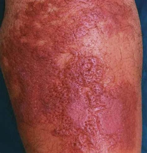 Как выглядит рожистое воспаление на ноге фото – 28 шт. | Ноги