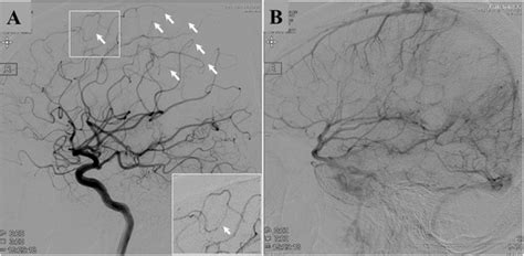 Lateral View Of Right Internal Carotid Angiography Of Arterial Phase Download Scientific