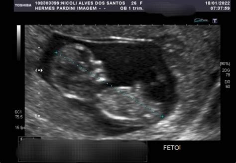 Ultrassom Bebe 3 Meses - Ultrassom 3 meses | BabyCenter