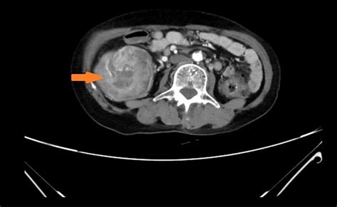 Frontiers Case Report An Adult Intussusception Caused By Ascending Colon Cancer