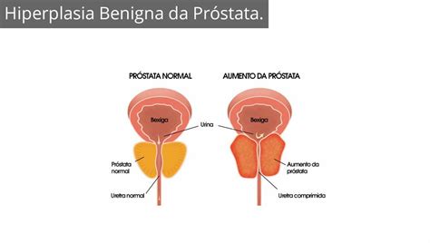 Hiperplasia Prostática O Que É - Cividanes - Hiperplasia Benigna da Próstata.