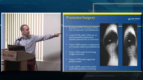 Scheuermanns S Disease Kyphosis Youtube