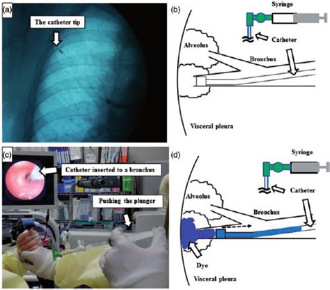 The Technical Explanation Of Virtual Assisted Lung Mapping A The