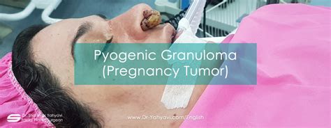 Pyogenic Granuloma Pregnancy Tumor Removed By Dr Yahyavi Dr