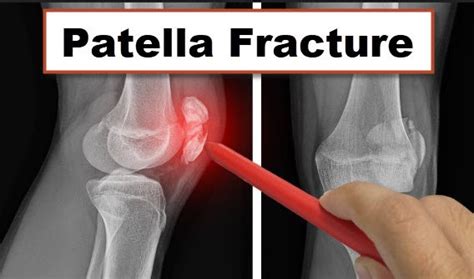 Patella Fracture Repair