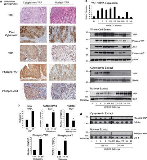 Predominantly Cytoplasmic Vs Nuclear YAP Localization Is Associated