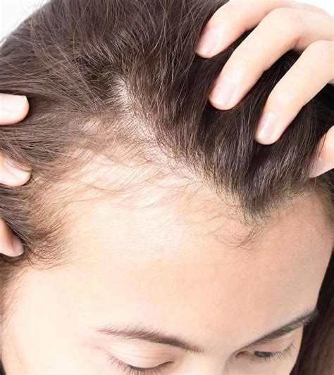 10 Home Remedies To Regrow Hair On Bald Patches Artofit