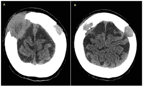 A Brain Ct Scan Shows A Lytic Lesion At The Right Parietal Bone