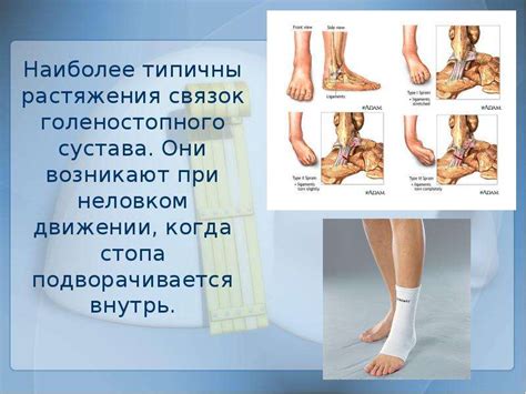 Упражнения при растяжении связок голеностопа: ЛФК при разрыве связок ...