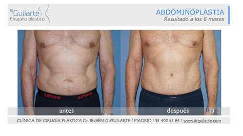 Abdominoplastia Madrid Precio Cirug A Abdominal Dr Guilarte