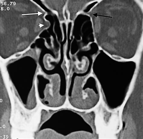 Figure 1 From The Relationship Between Ethmoidal Foramina And Orbital