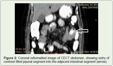 Jejunojejunal Intussusception A Rare Case In Adults