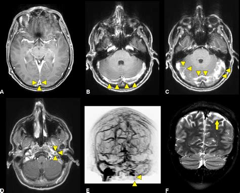 Cerebral Venous Sinus Thrombosis Precipitated By Graves Disease Bmj