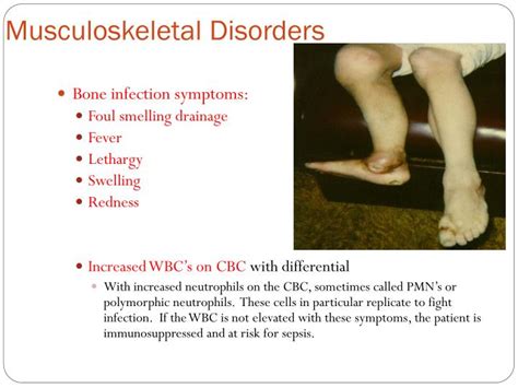 Ppt Musculoskeletal Disorders Part Ii Powerpoint Presentation Id