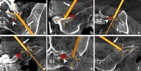 Sequential Endoscopic Rhizotomy And Ablation On L5 S2 And S3 Axial