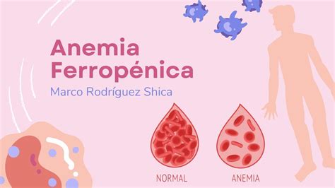 Anemia Ferrop Nica Marco Rodr Guez Udocz