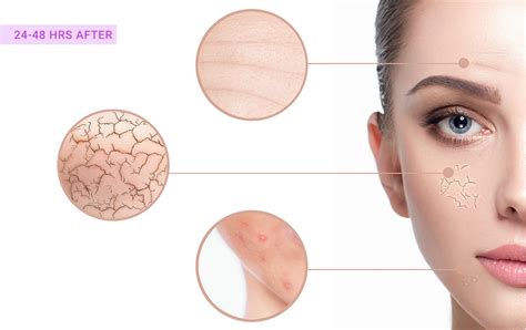 Is Skin Peeling After Microneedling Normal Dermapen