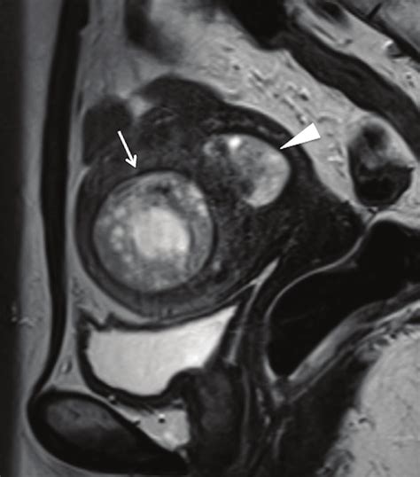 Sagittal T 2 Weighted Image Wi An Intramyometrial Mass In The