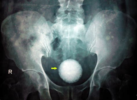 Squamous Cell Carcinoma Of Bladder