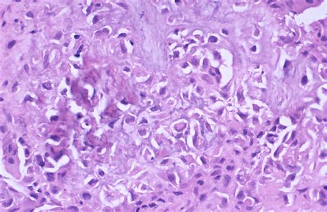 Chondroblastoma Libre Pathology