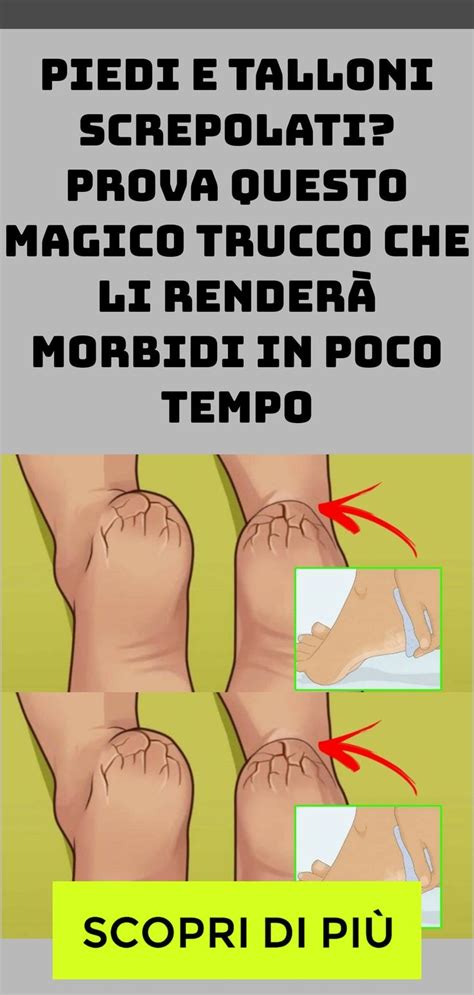 Piedi e talloni screpolati Prova questo magico trucco che li renderà