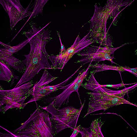 Multiple Myeloma | NYU Langone Health