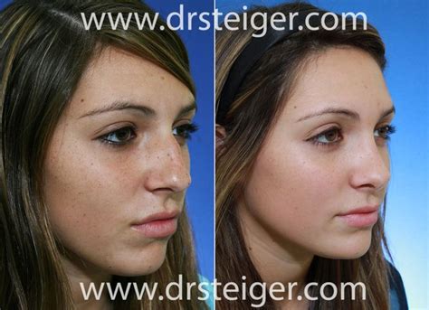 Deviated Septum Nose Job Before And After Magali Puente