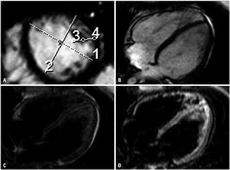 Supplementary Diagnostic Landmarks Of Left Ventricular Non Compaction