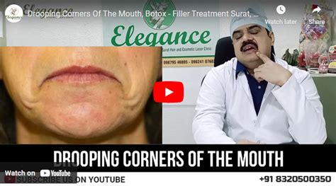 Drooping Corners Of The Mouth Elegance Clinic