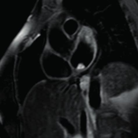 Cardiac Mri A Cine Image Ssfp Sequence Of The Left Atrial Mass B