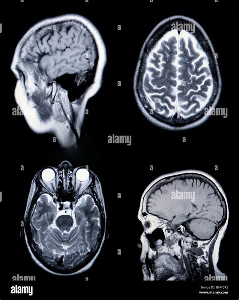 Arterias Del Cerebro Fotografías E Imágenes De Alta Resolución Alamy