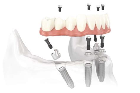 Full Arch Dental Implants in Los Angeles | OMSI LA