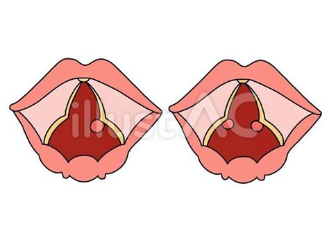 Free Vectors | Vocal cord polyps and vocal cord nodules No text color