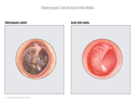 Middle ear and eardrum - HNO Sarnen