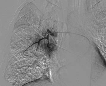 CT Guided Percutaneous Embolization Of A Rasmussen Aneurysm With