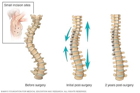 Tethered Cord Syndrome Mepedia 48 Off