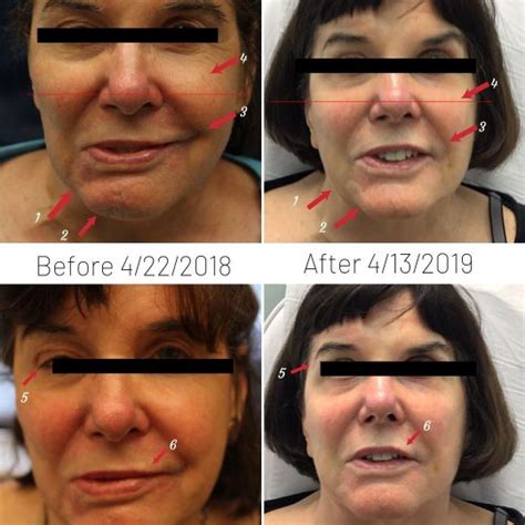 Bells Palsy Treatment Bello Medical Aesthetics