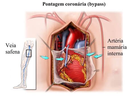 Revascularização Do Miocardio Cirurgia E Tempo De Recuperação