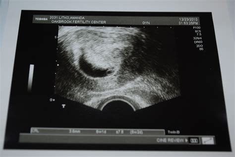 From Here To Maternity: ultrasound- 6 weeks 2 days