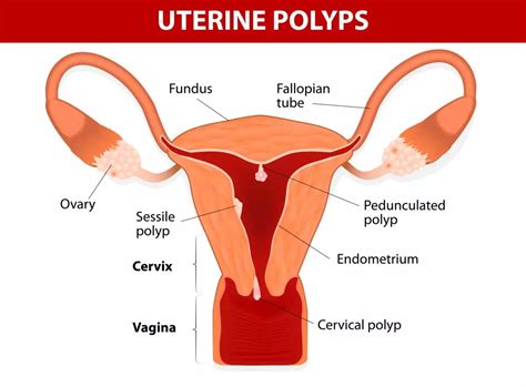 Fibroids vs. Polyps: What You Need to Know - Responsum for Fibroids