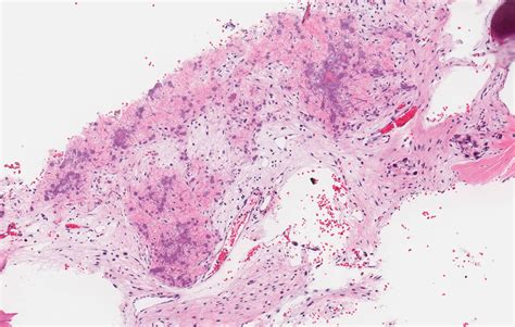 Pathology Outlines Simple Bone Cyst