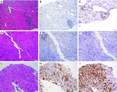 Tumor Infiltrating Cd Ctls In Pdac Immunohistochemistry For Cd And