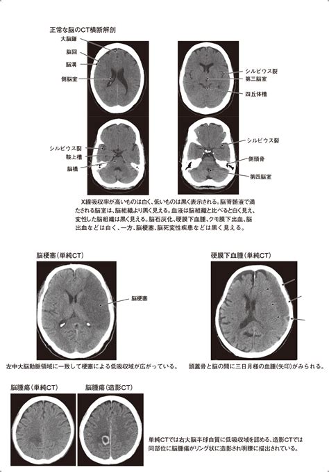 頭部ct 脳底 見逃し Hosevensxy