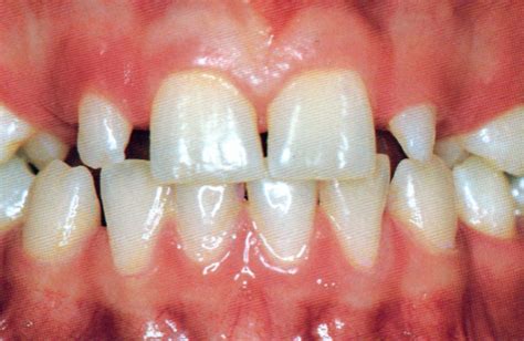 Unraveling Abnormalities of Permanent Teeth | Bücco