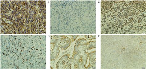 Immunohistochemistry Of Cd133 Cd117 And Ki67 Proteins In Gist And The