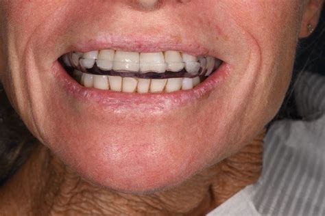 Periodontal Disease Gum Disease Northshore Dental And Oral Health