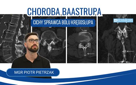 Choroba Baastrupa Cichy sprawca bólu kręgosłup Rehmedis pl