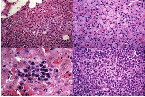 Boxer Dog Photomicrography Of Plasma Cell Tumor There Is Severe And