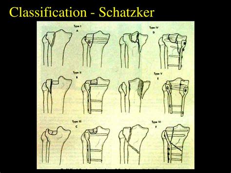 Schatzker Classification Of Tibial Plateau Fractures Uw Emergency Images